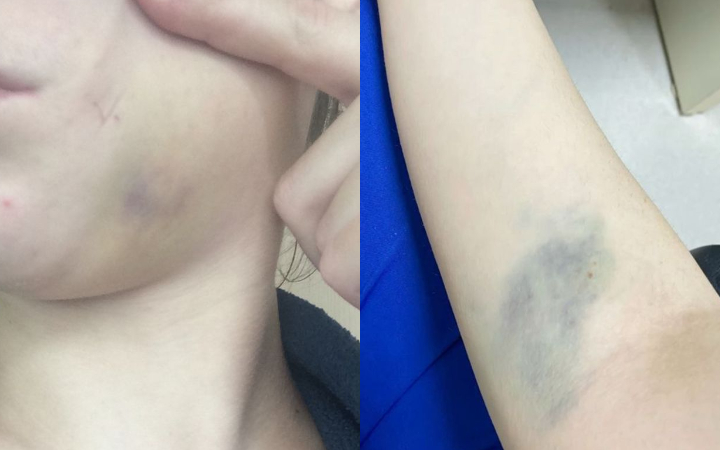 Bangun tidur dan tubuh tiba-tiba memar padahal tidak terbentur apa pun? Kondisi ini ternyata bisa dijelaskan secara medis. Simak faktanya di sini.