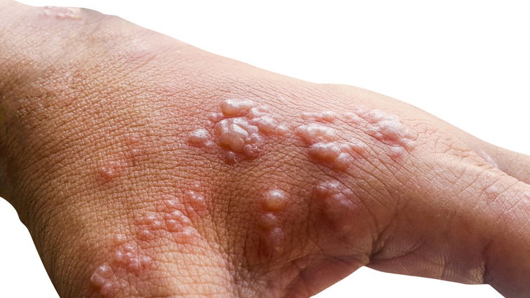 NGERI: Gejala mpox yang perlu diwaspadai munculnya demam di atas 38 derajat Celcius, ruam, lesi atau keropeng kulit di wajah, telapak tangan dan kaki, serta alat kelamin. (IST/GETTY IMAGES)