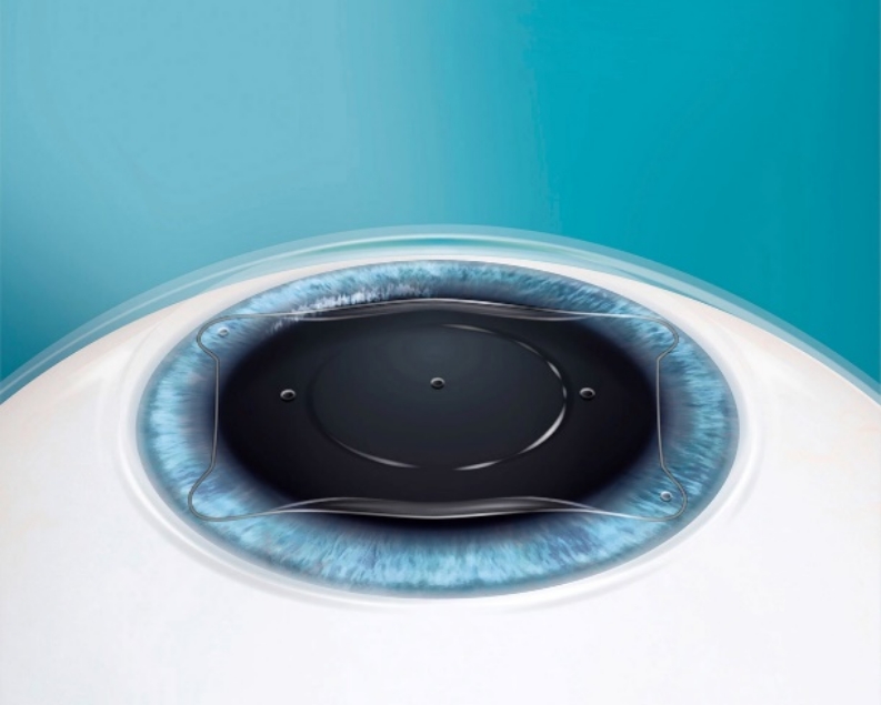 Implantable Collamer Lens (ICL) atau Phakic IOL