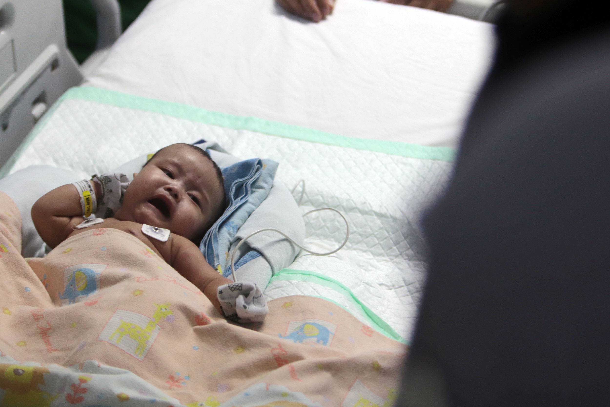 Bayi kembar siam asal Tulungagung Arselllo yang bertahan hidup, sedangkan saudara kembarnya Arsennio meninggal dunia usai 9 jam menjalani operasi pemisahan di RSUD Dr Soetomo Surabaya.