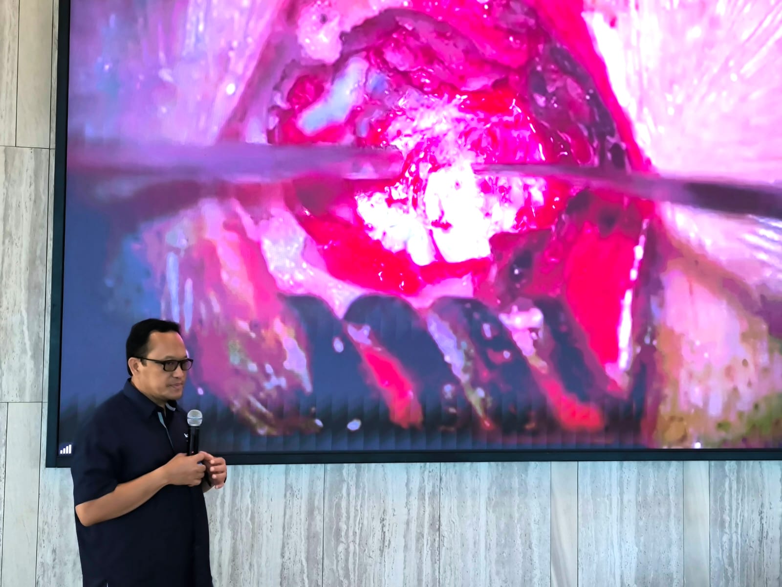 Live Surgery MVD: dr Agus Choirul Anam (ACA) menjelaskan proses operasi Microvascular Decompression (MVD) terhadap pasien Hemifacial Spasme atau wajah kedutan secara live.