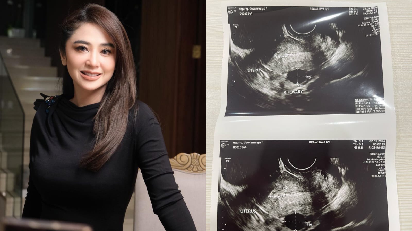 Dewi Perssik dan hasil USG yang diunggahnya melalui instagram.