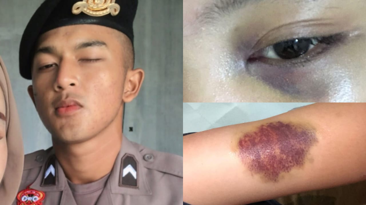 Onum anggota Polda Jabar yang menganiaya kekasih dan bukti luka lebam pada tubuh korban.