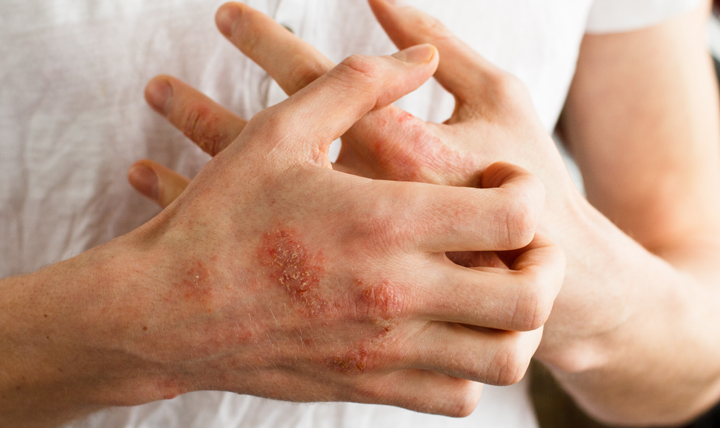 Kusta adalah penyakit menular menahun yang disebabkan Micobacterium Leprae.