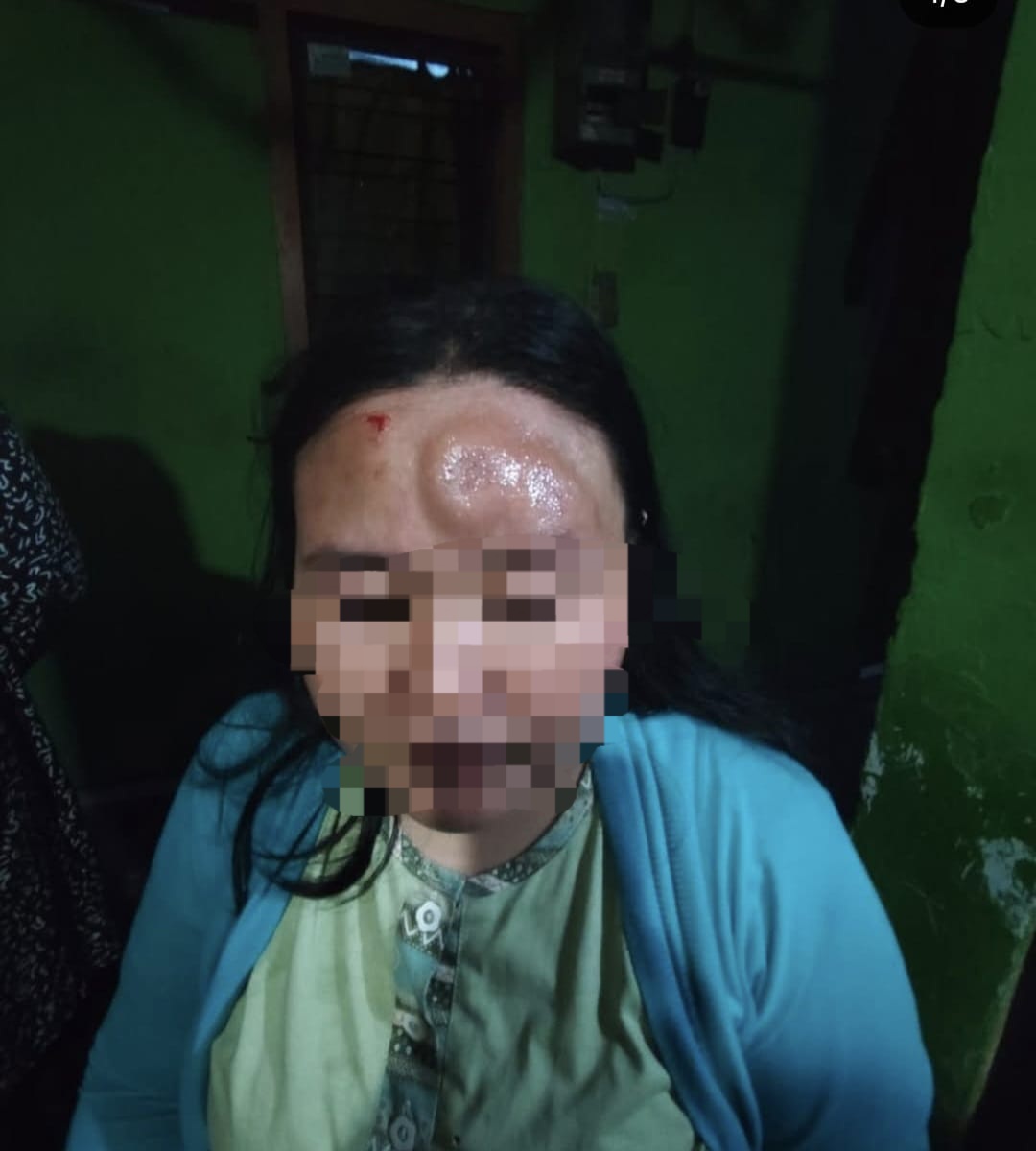 PARAH : Korban mengalami luka di kepala dan wajahnya usai menjadi korban KDRT suaminya di rumah Jalan Dukuh Menanggal, Surabaya. (IST/RADAR SURABAYA)