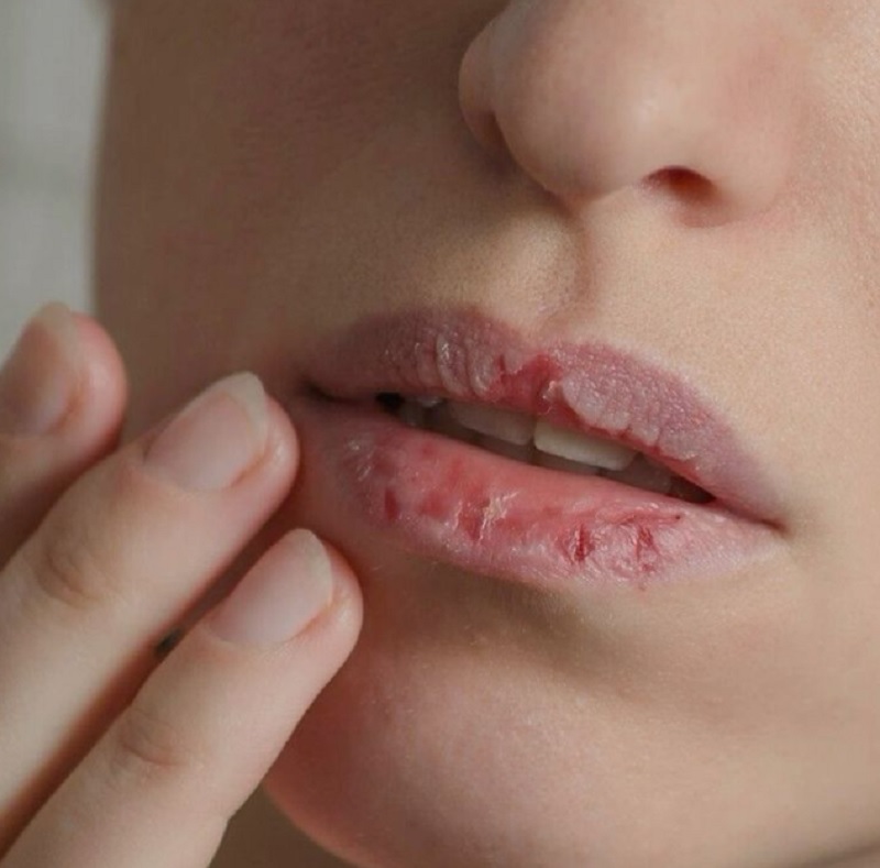 Saat bibir kering atau pecah-pecah, banyak orang tergoda untuk mengelupas kulitnya secara manual, padahal bias berbahaya.