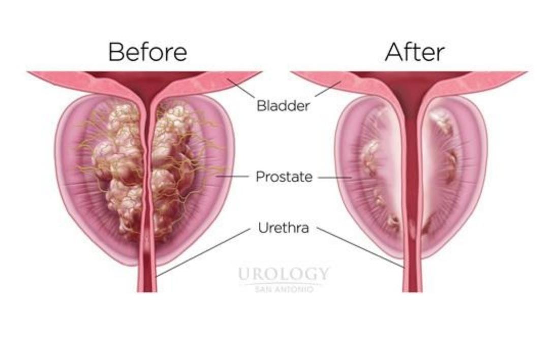 Perbandingan sebelum dan sesudah terapi rezum. Source / courtesy: urology san antonio