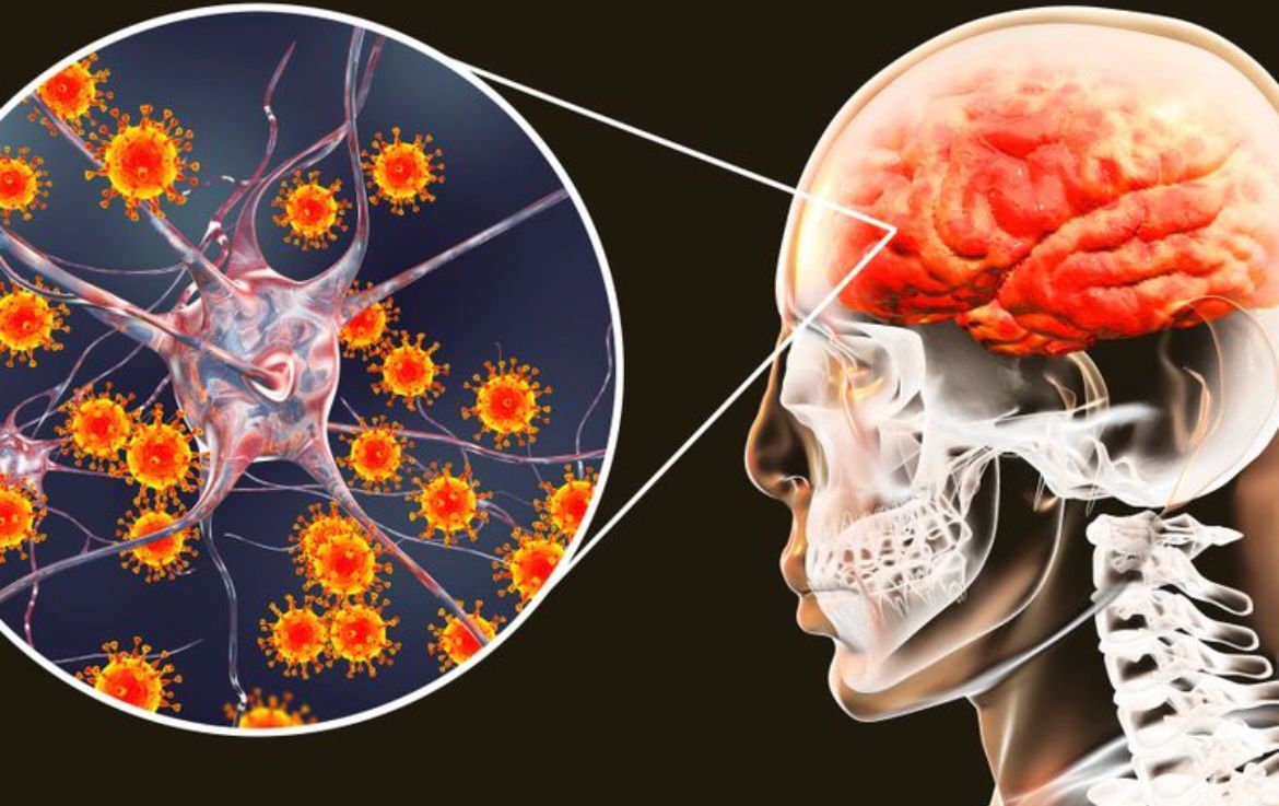 Waspadai meningitis kenali gejalanya sebelum terlambat.