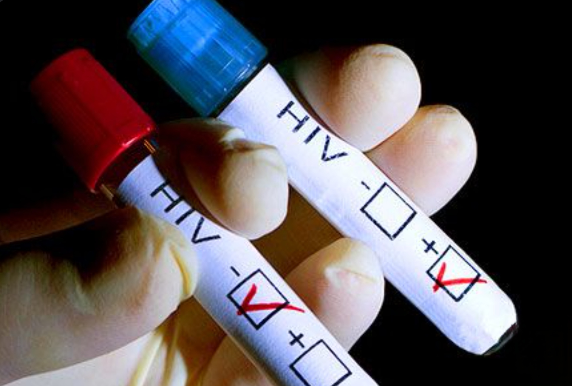 Ilustrasi hasil tes HIV/AIDS.