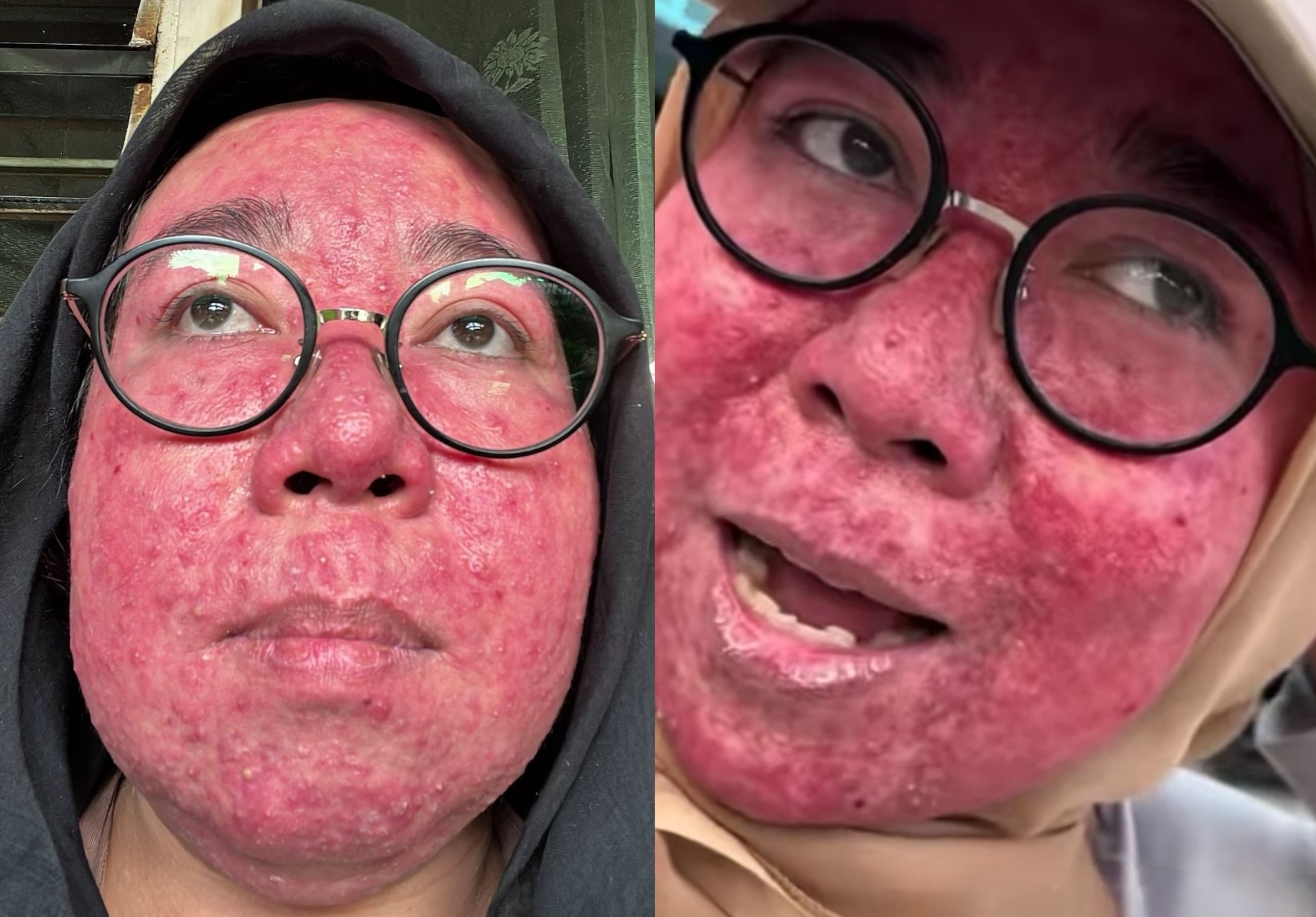 Kondisi wajah Desty yang &ldquo;babak belur&rdquo; akibat penggunaan krim etiket biru yang mengandung steroid.