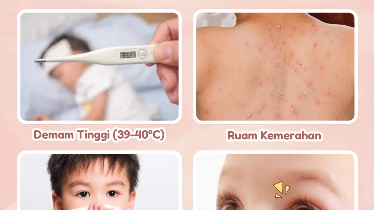 Penyakit campak perlu diwaspadai khususnya pada anak-anak. (IST)