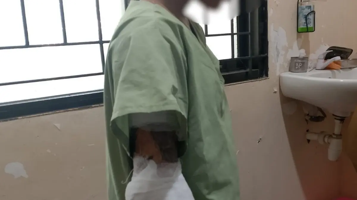 Luka bakar yang dialami T, siswi SMP di kawasan Tambakmulyo, Semarang Utara yang menjadi korban pembakaran oleh pamannya sediri. (ISTIMEWA)