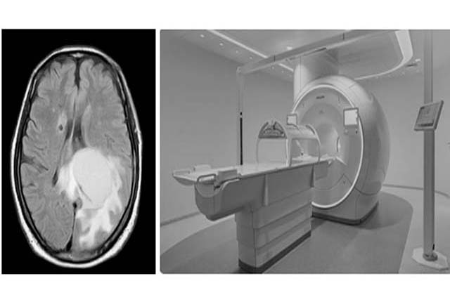 Abses otak yang dapat menyebabkan kematian (foto kiri) dan peralatan MRI yang bisa mendeteksi dini adanya abses otak pada pasien. (foto kanan). (ISTIMEWA)