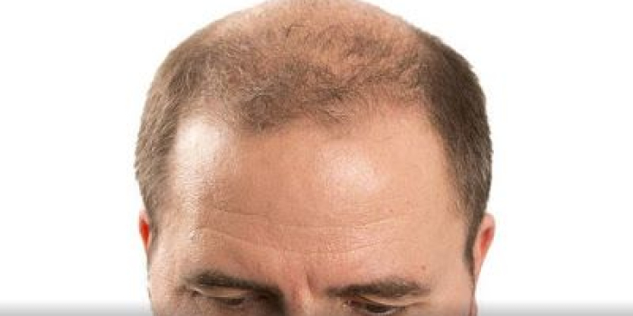 Kerontokan pada rambut kepala