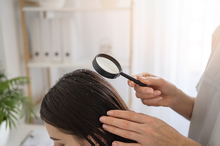Say goodbye to ketombe! Temukan solusi alami yang ampuh untuk kulit kepala sehat dan rambut bebas ketombe (freepik)