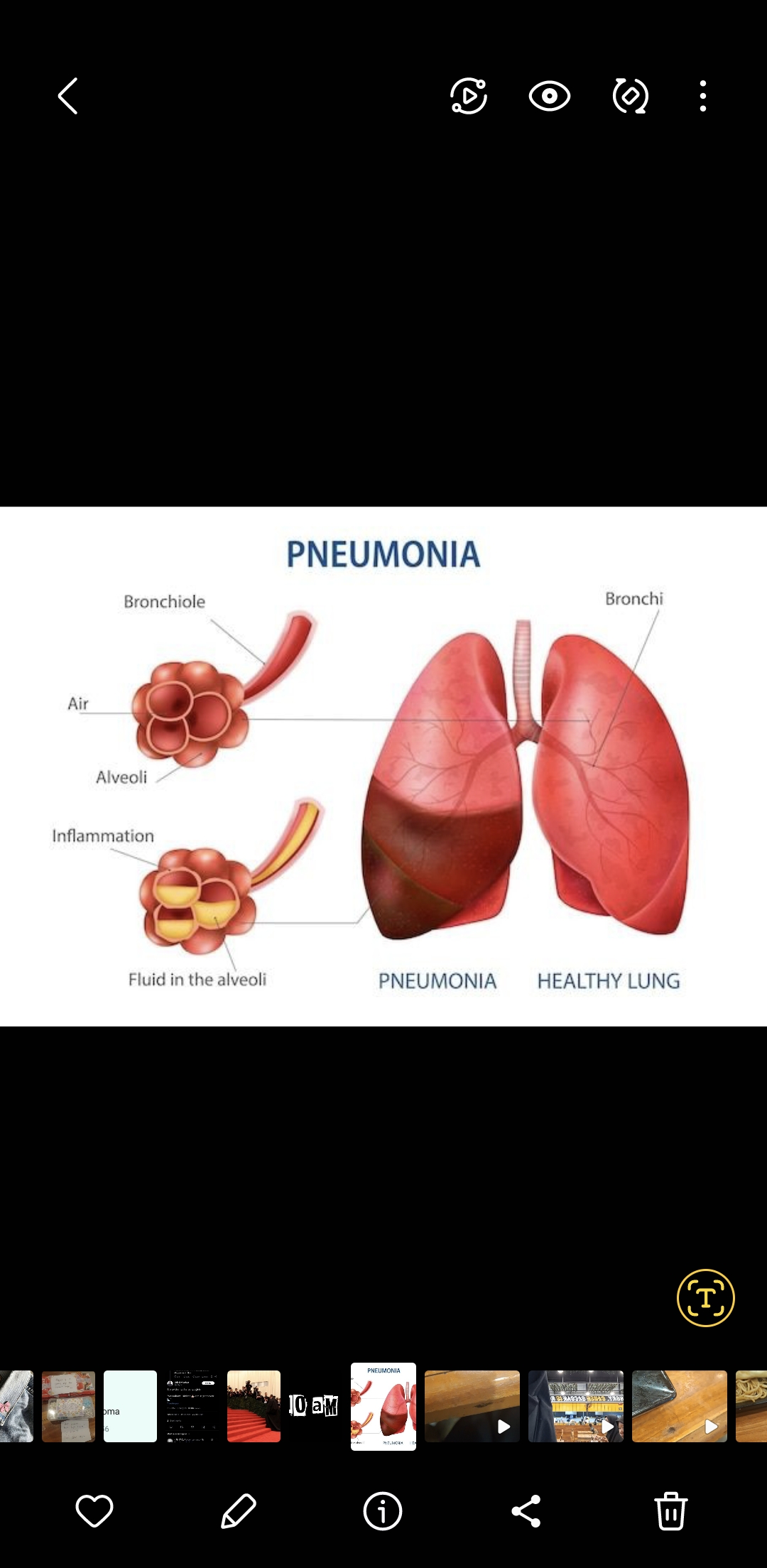 Ilustrasi Pneumonia
