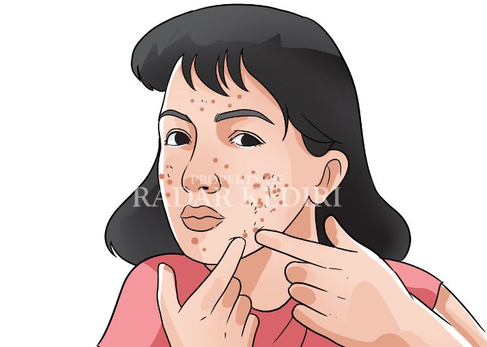 ILUSTRASI: Wajah bopeng.