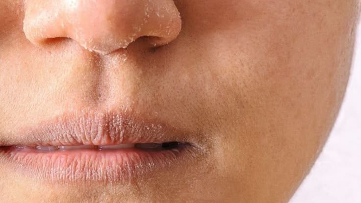 Ilustrasi Kondisi Kulit Kering