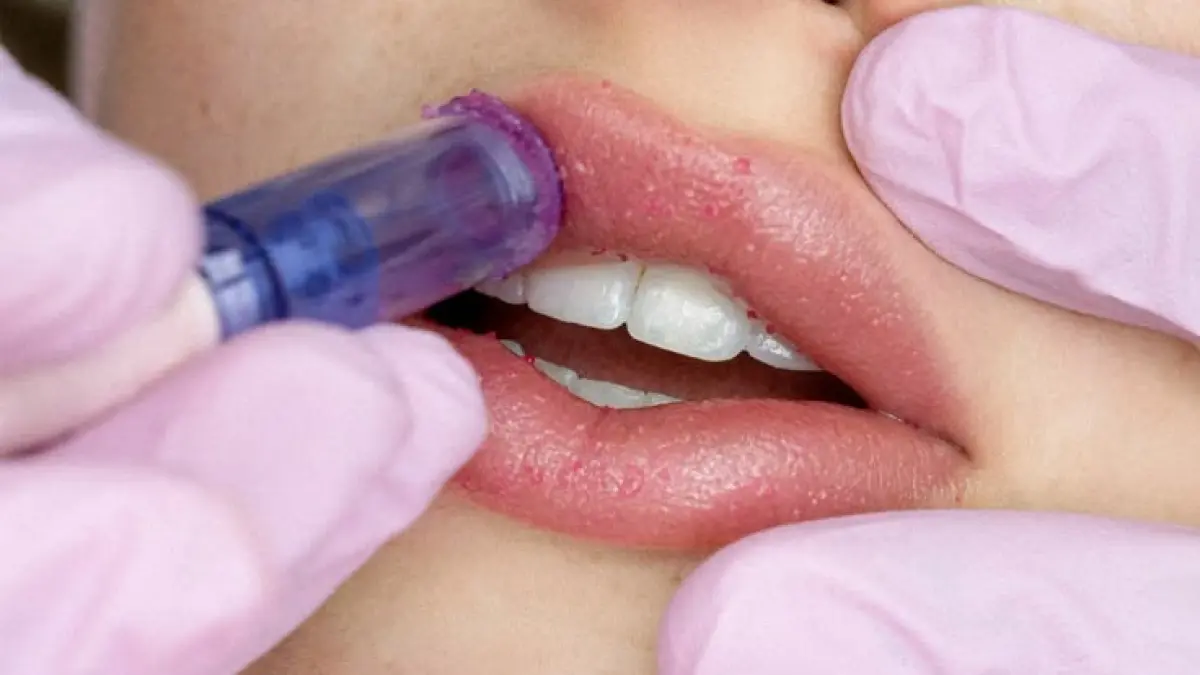Ilustrasi treatment laser bibir (Pinterest)