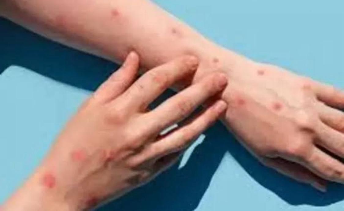 GATAL : Ilustrasi penyakit Mpox atau cacar monyet yang membuat penderita merasakan gatal cukup parah.