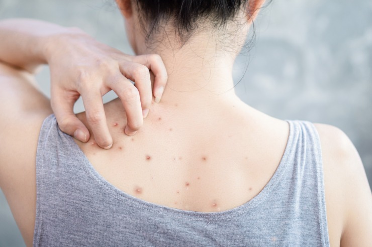 Ilustrasi jerawat pungung (iStock)