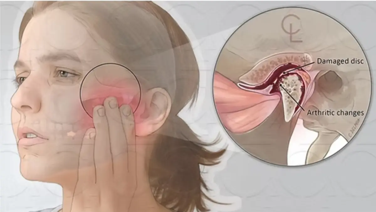 Temporomandibular Disorder (TMD)”, yaitu gangguan pada sendi yang menghubungkan rahang bawah dengan tengkorak kepala Anda. 
Foto : Lim (2025)