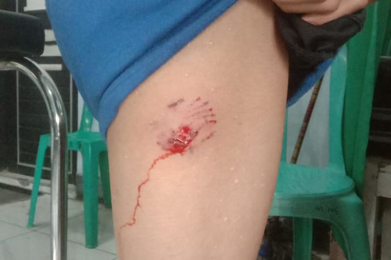 Luka korban akibat gigitan anjing rabies di Dompu, NTB