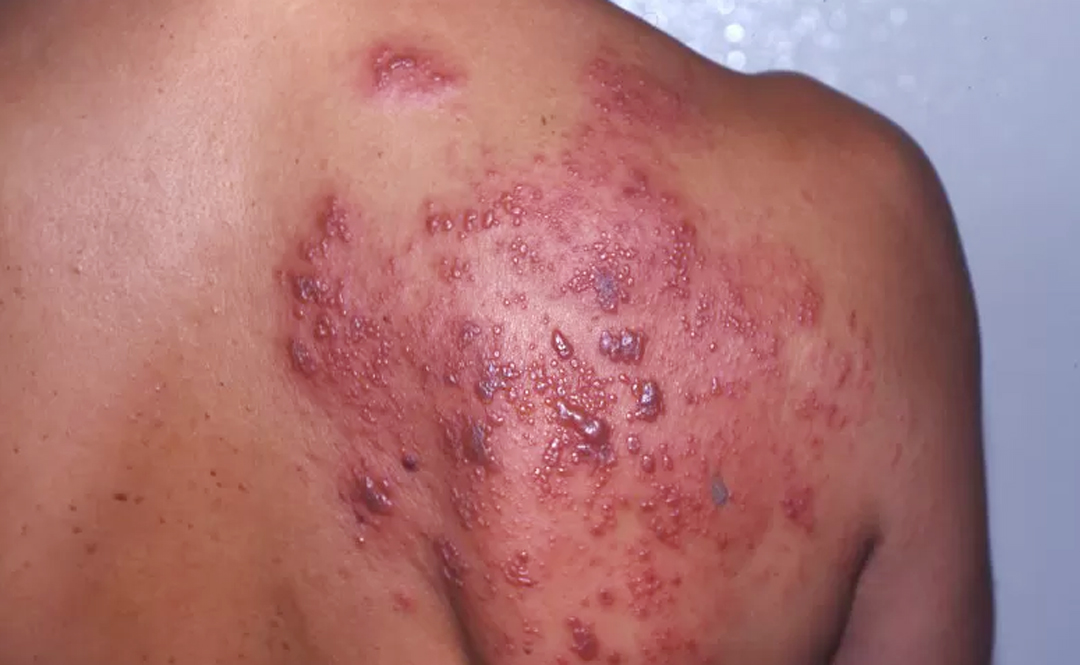 Herpes merupakan penyakit menular yang disebabkan virus. (americanskin.org)