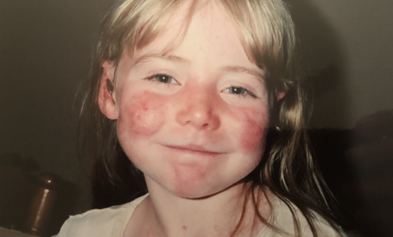 Ilustrasi penyakit kulit langka Epidermolysis Bullosa (RACGP)