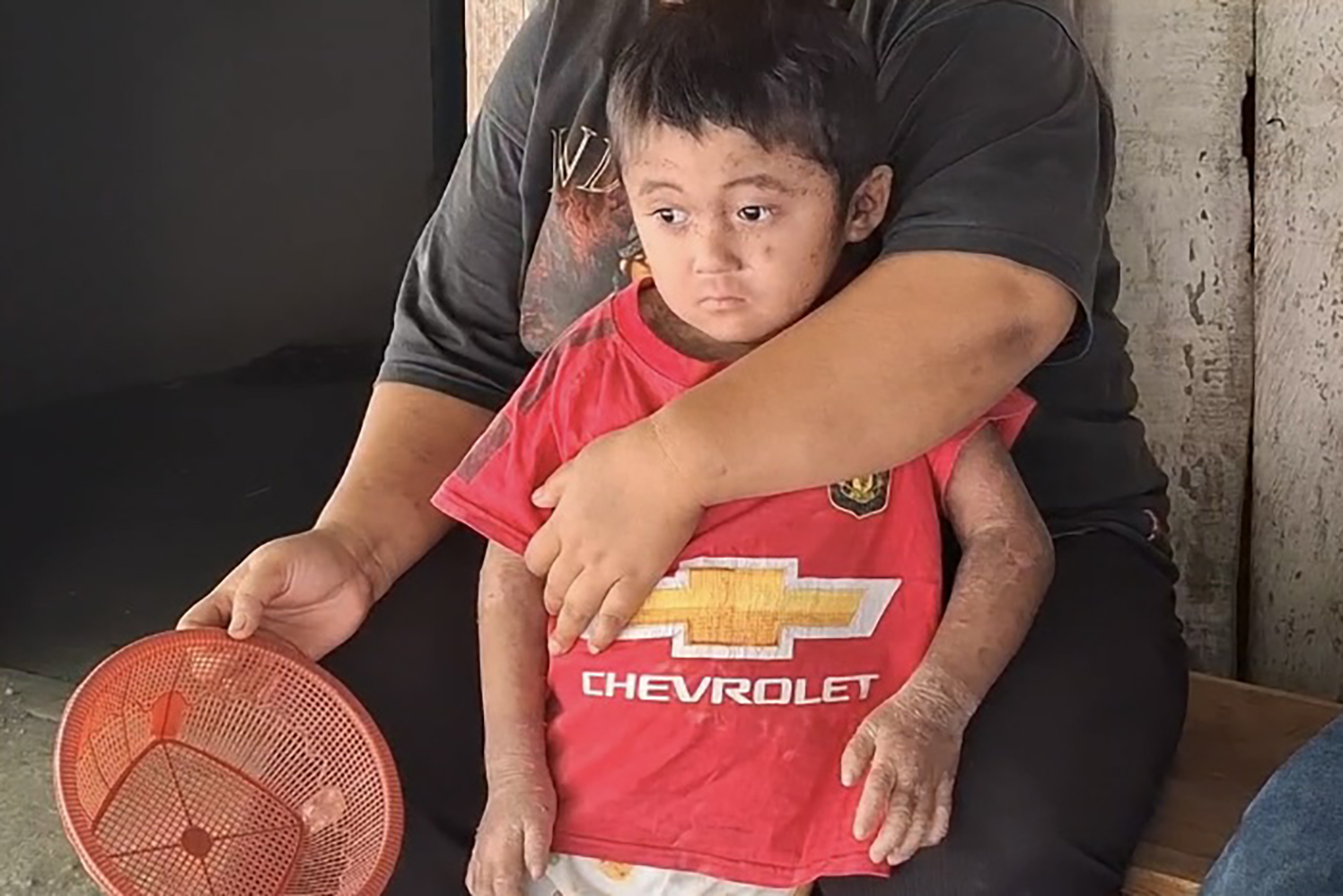 INTENS DIPANTAU: Kondisi tubuh Alfi Aska Fahrul Rohim, balita pengidap penyakit langka rawan semakin parah di musim kemarau.&nbsp;(DIAN RAHAYU/RADAR MADIUN)