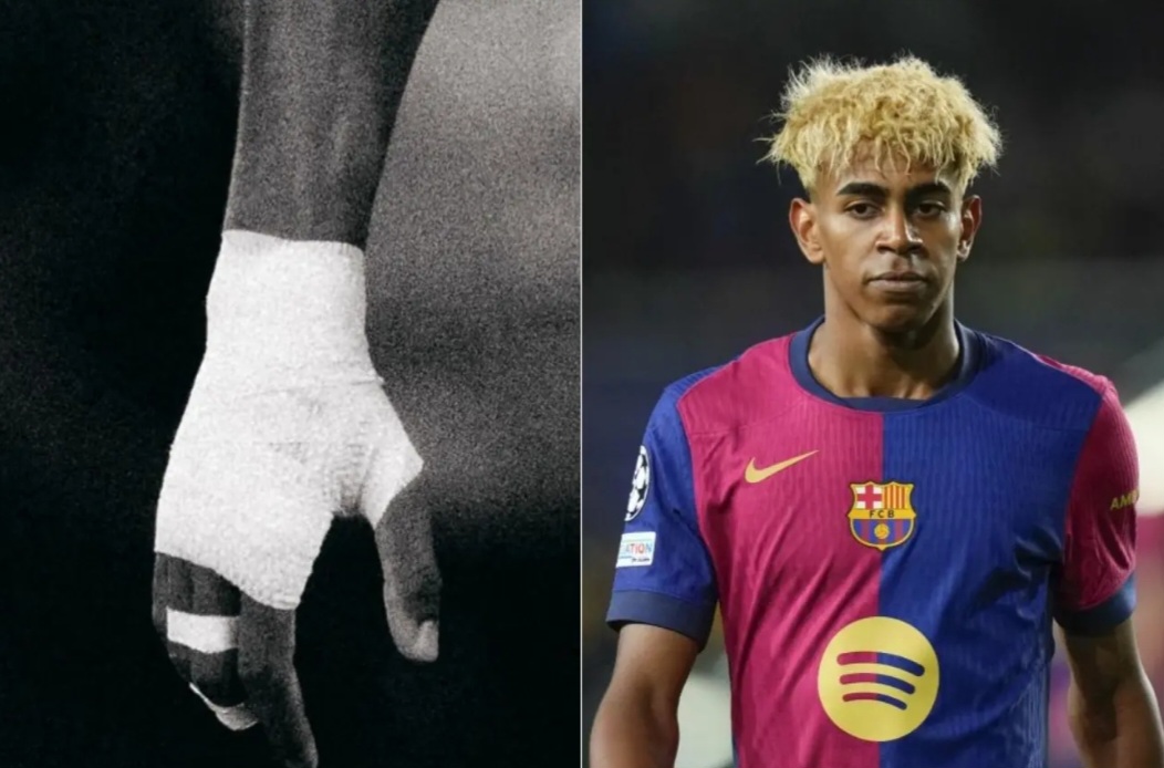 Lamine Yamal unggah foto sindiran soal perban di tangan usai laga vs Inter.