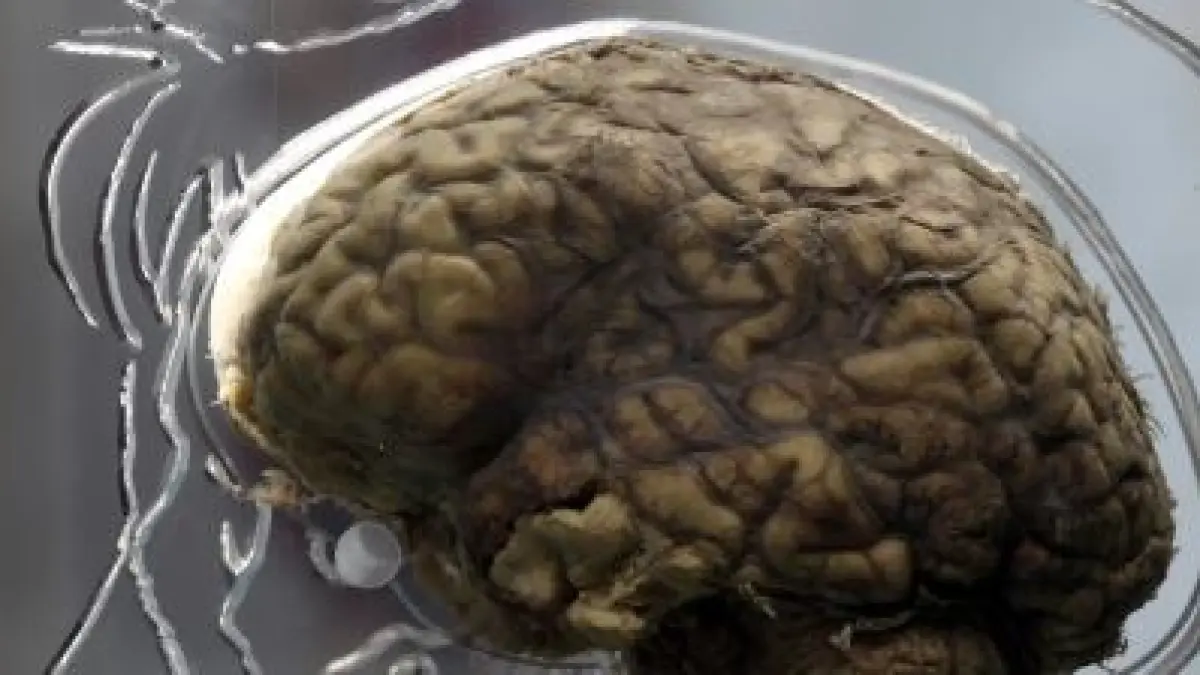 Cotard’s Syndrome. (ISTIMEWA)