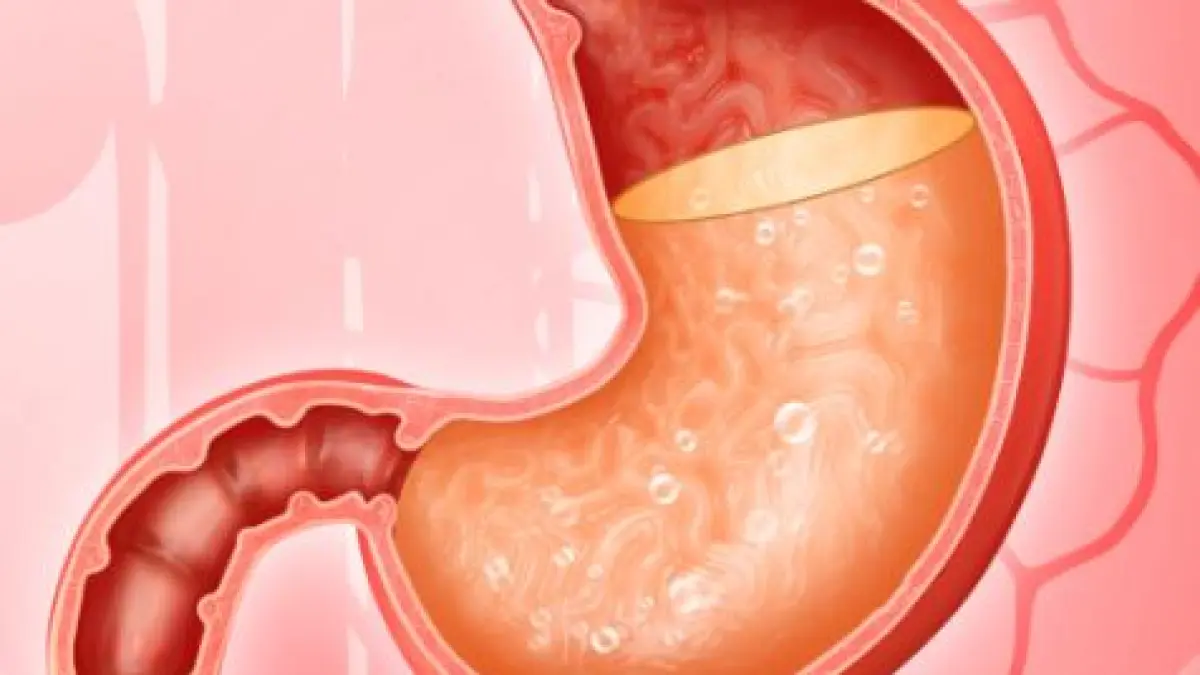 Fungsi asam lambung bagi tubuh. (ILUSTRASI/ISTIMEWA)