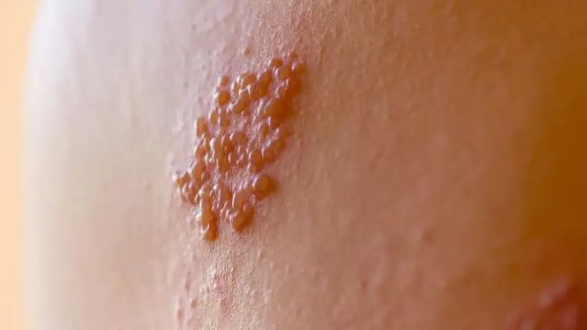 Ilustrasi herpes. (ISTIMEWA)