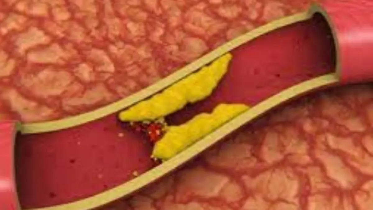 Ilustrasi kolesterol tinggi. (ISTIMEWA)