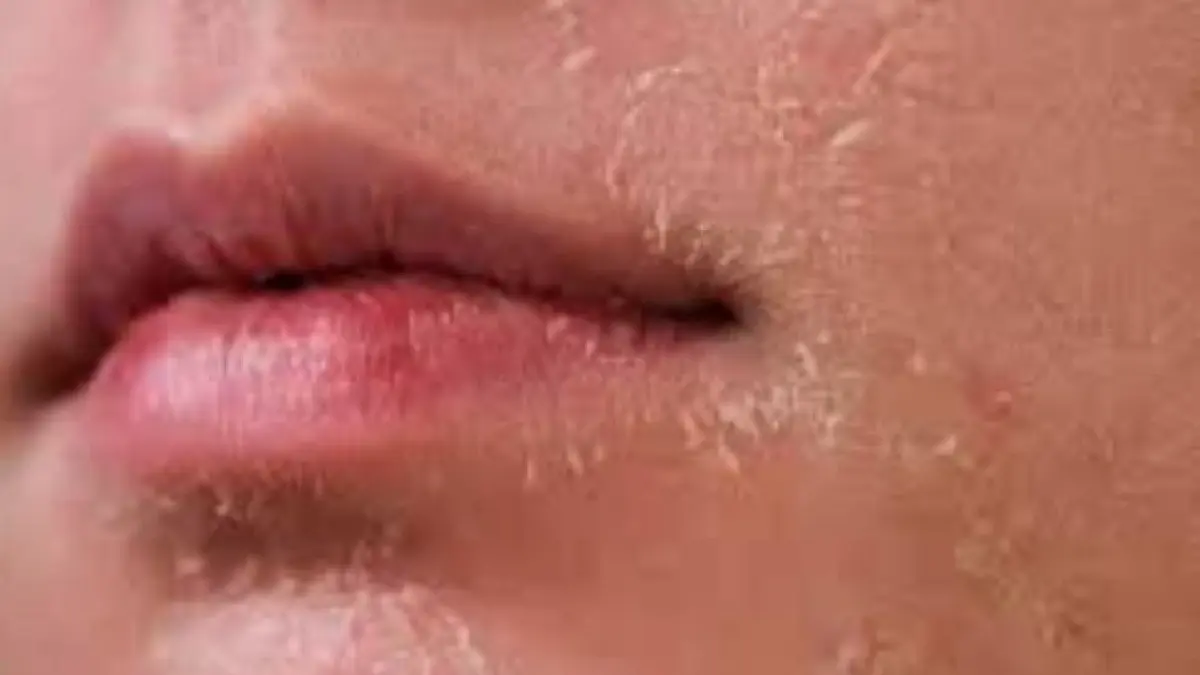 Ilustrasi ganti kulit. (ISTIMEWA)