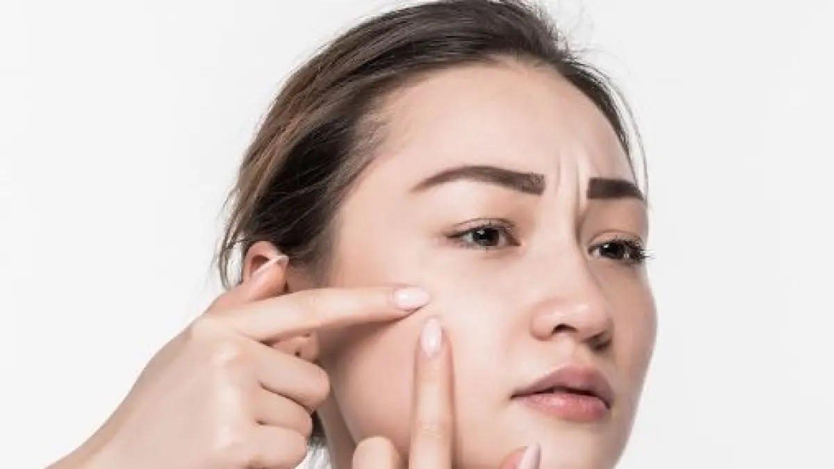 Cara Menghilangkan Bintik Putih 