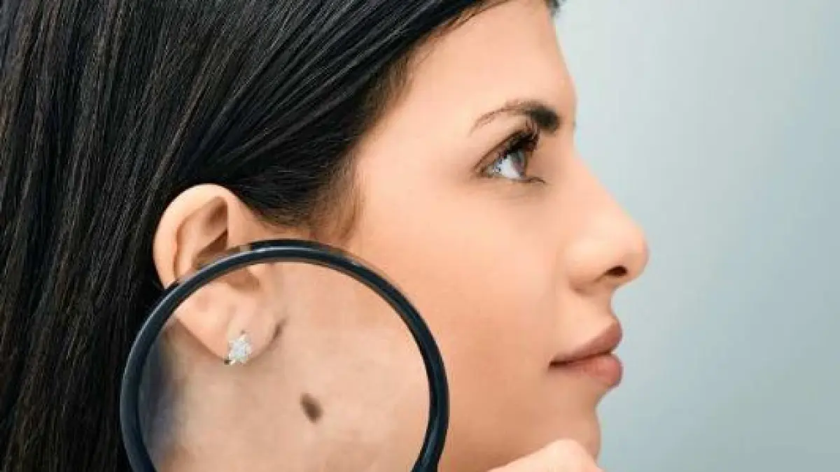 Flek Hitam, Melasma, dan Melanoma