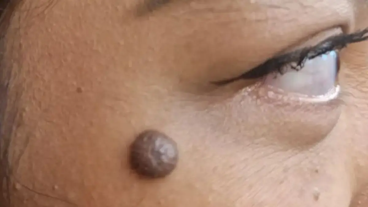 Tahi Lalat