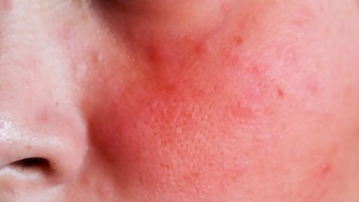 Wajah Merah Akibat Skincare