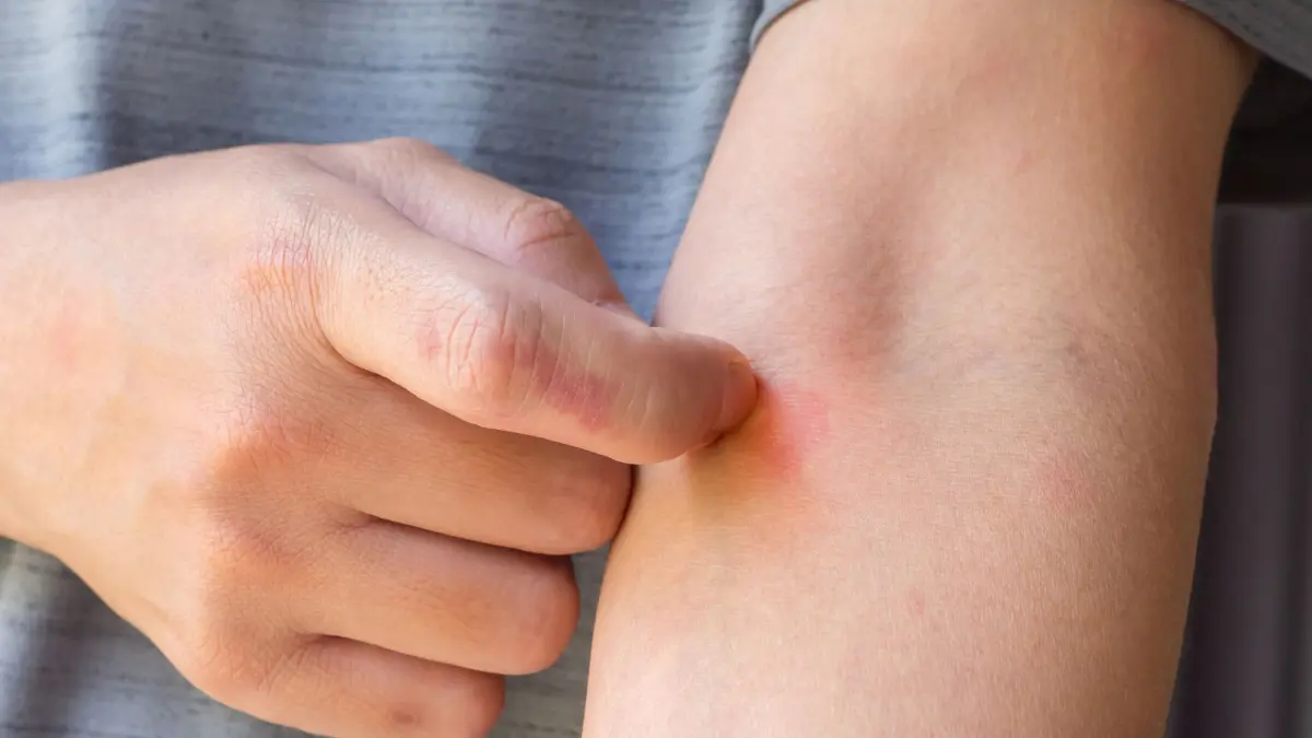 Bentol kemerahan akibat alergi dingin. Sumber: Kwangmoozaa / Getty Images