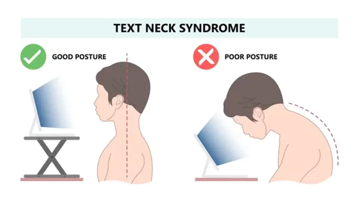 ilustrasi text neck syndrome (chennaispinecare.com)