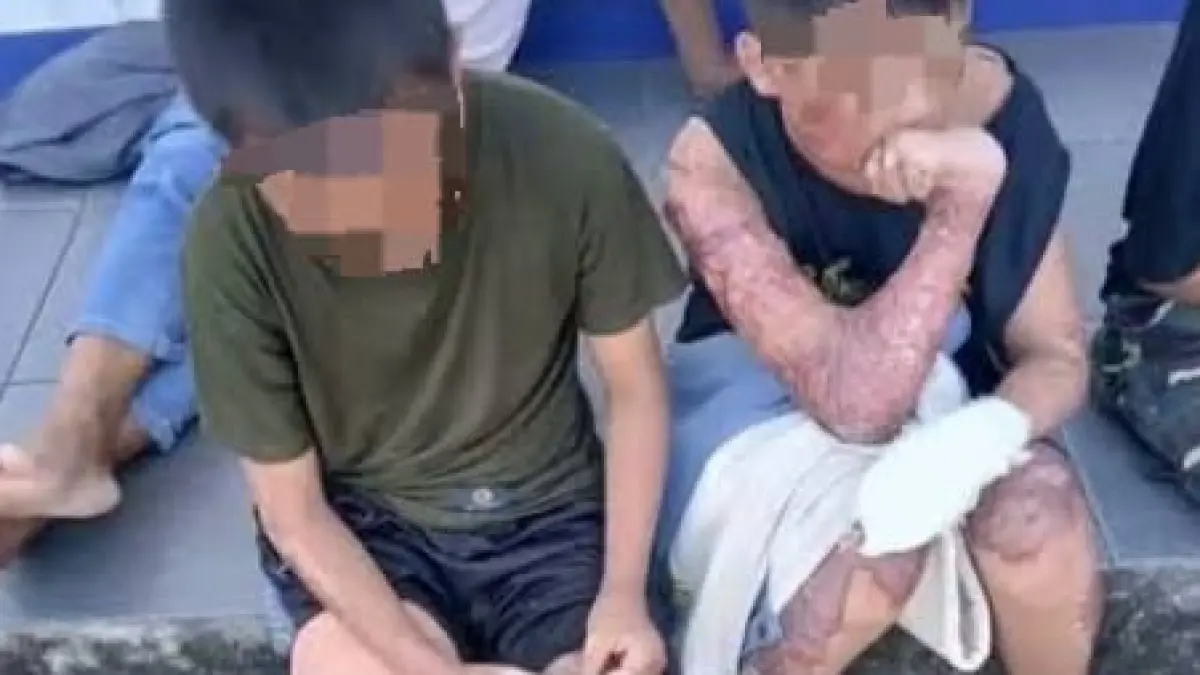 Memperlihatkan Santri dengan Luka Bakar di Tubuhnya (Sumbarzonews)