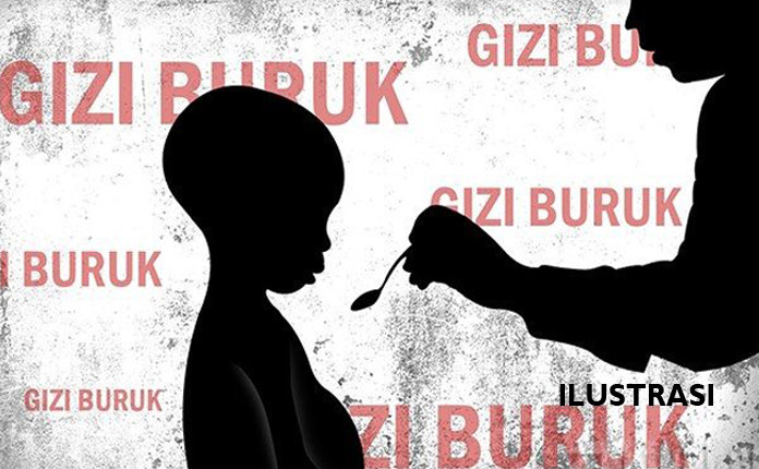 ILUSTRASI foto bayi stunting