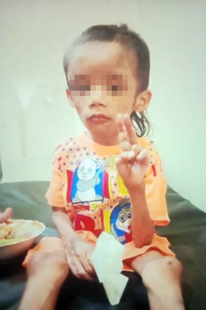 Foto, DN, 7, bocah asal Buring yang dianiaya keluarga sendiri, masih mendapat perawatan intensif di RSSA Malang.