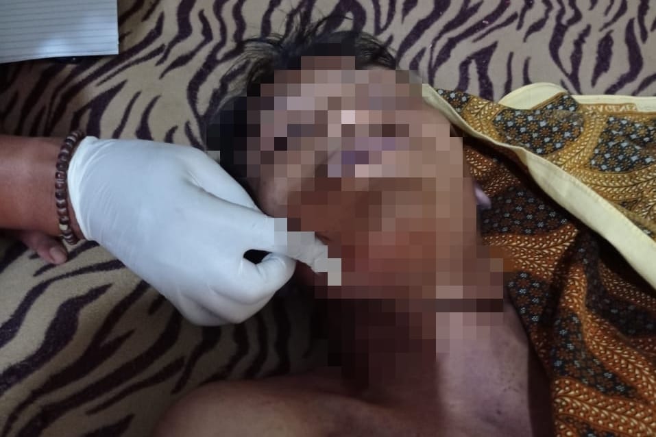 Korban R warga Wonosari Kabupaten Malang yang lehernya menunjukkan luka jerat akibat gantung diri