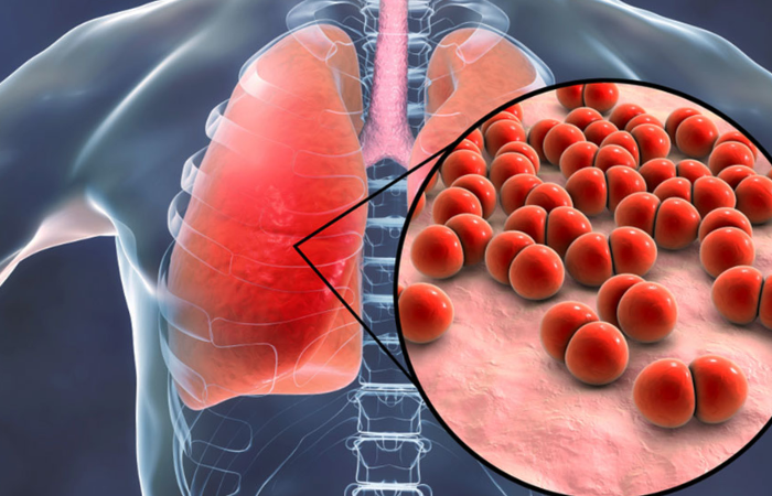 Mengenal lebih dalam penyakit Pneumonia Ganda yang mengganggu stimulan paru-paru (Ausmed)