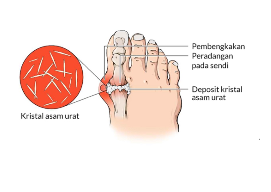 ASAM URAT: Nyeri sendi akut yang disebabkan penumpukan kristal asam urat di sendi.