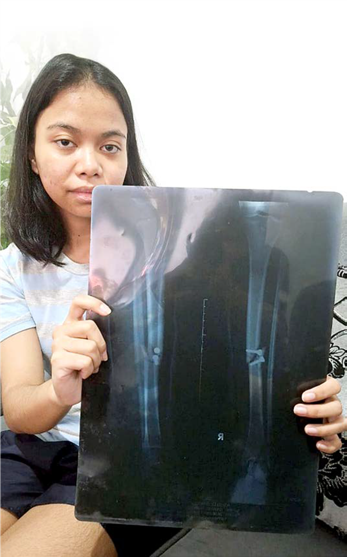 TERUS DIDAMPINGI IBU: Dian Puspita Sari, 25, warga Kecamatan Blimbing memperlihatkan foto rontgen yang menunjukkan patahan tulang kakinya.