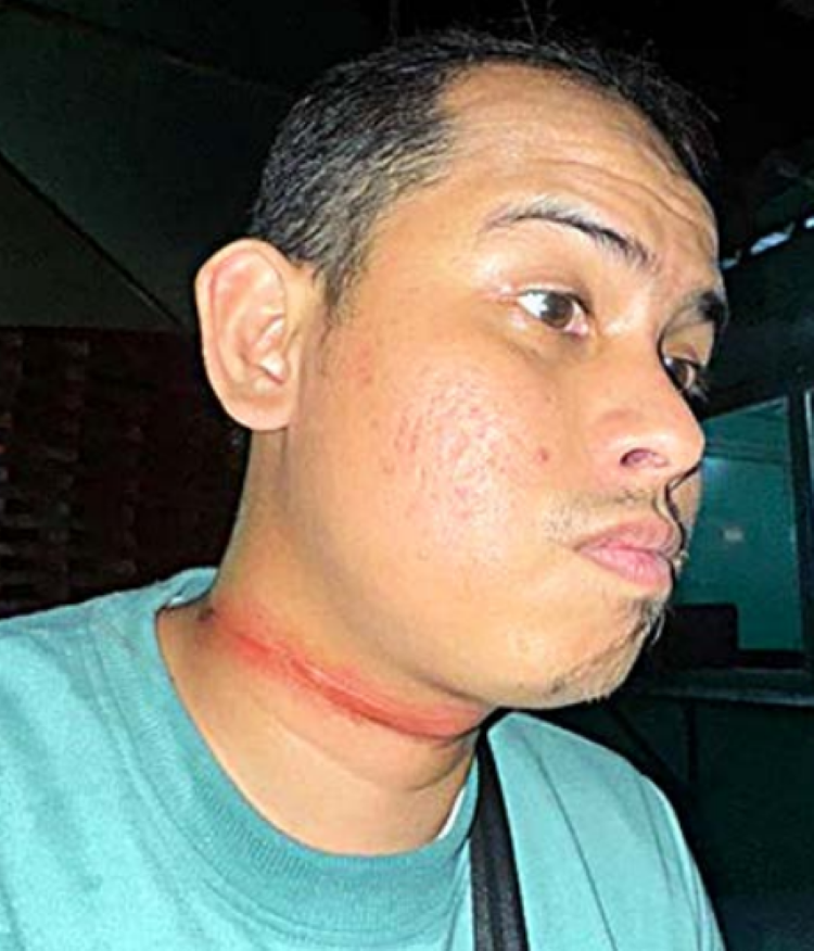 YANG KESEKIAN KALINYA: Kabel di Jalan Kawi Nomor 17, Kelurahan Kauman, Klojen membuat dua pengendara motor terjatuh. Rifki Safreza, warga Jakarta menunjukkan bekas jeratan kabel di lehernya.